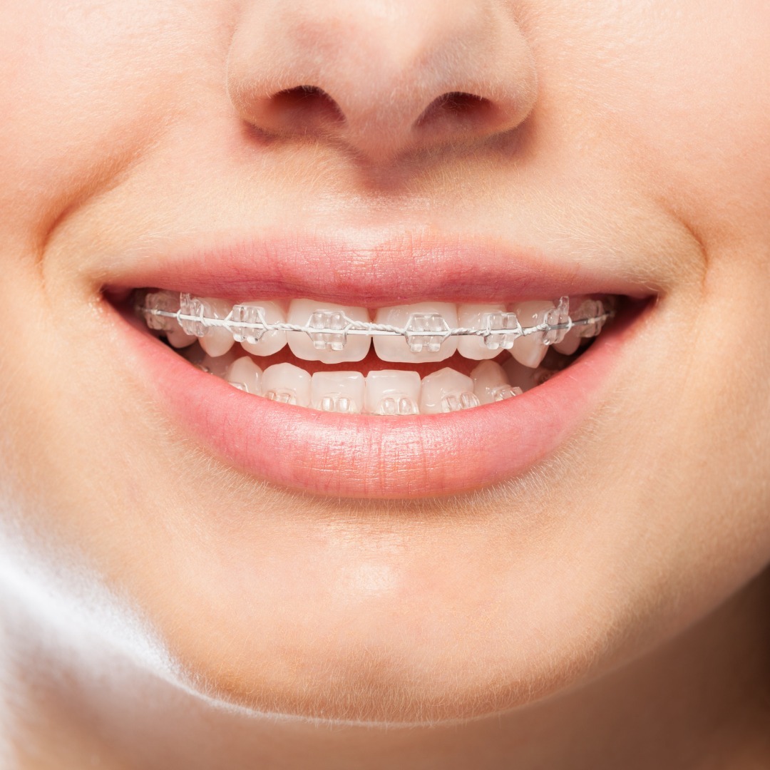 Lingual braces cost in Las Vegas 