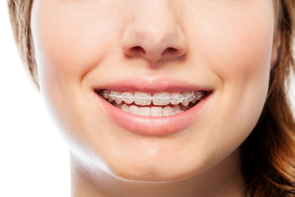 Invisible braces cost in Las Vegas