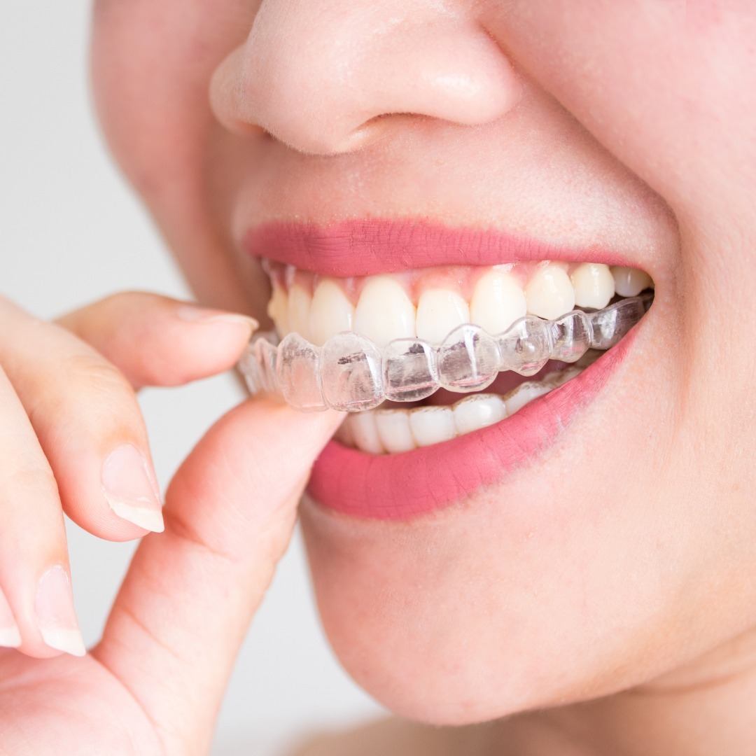 Invisible braces cost in Las Vegas