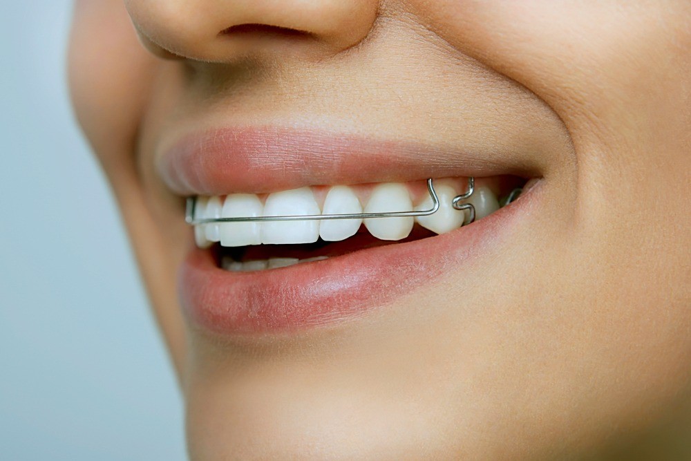 Invisible braces cost in Las Vegas